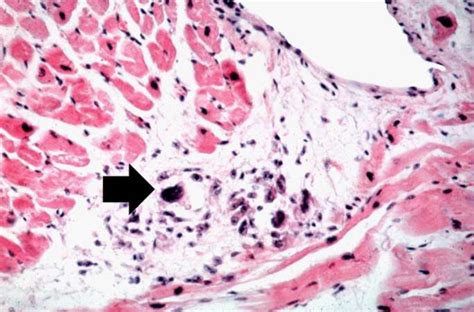 Acute rheumatic fever case study one - wikidoc