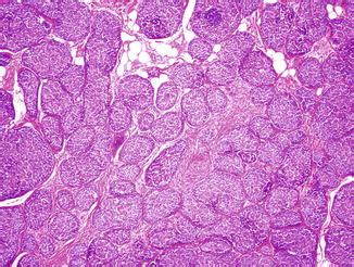 Malignant Cylindroma | Plastic Surgery Key