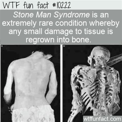 WTF Fun Fact - Stone Man Syndrome