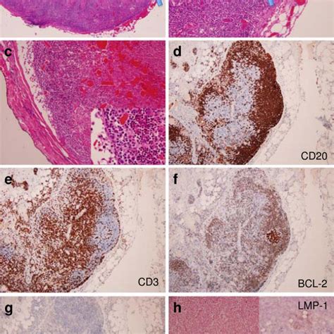 Excisional (1st) biopsy from cervical lymph node. a and b – low power ...