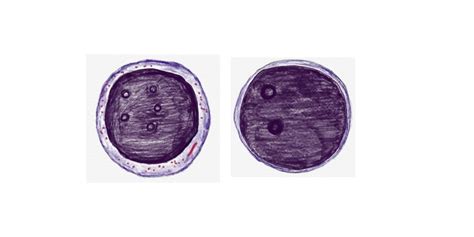 MYELOBLAST Vs LYMPHOBLAST - Pathology Made Simple