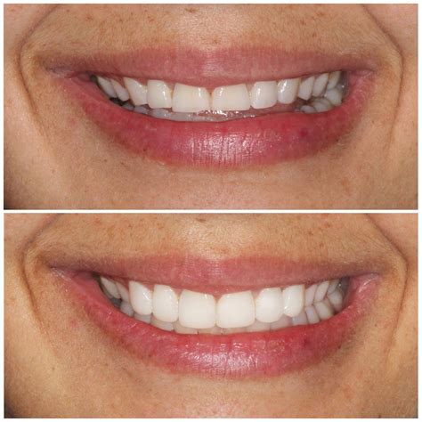 Composite Veneers Brisbane [Free Consult] | Smiling Dental