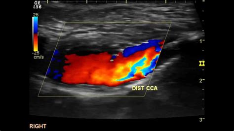 Cardio Vascular Ultrasound: Carotid Doppler, VNUS Closure, Arterial Doppler, AAA, and others ...