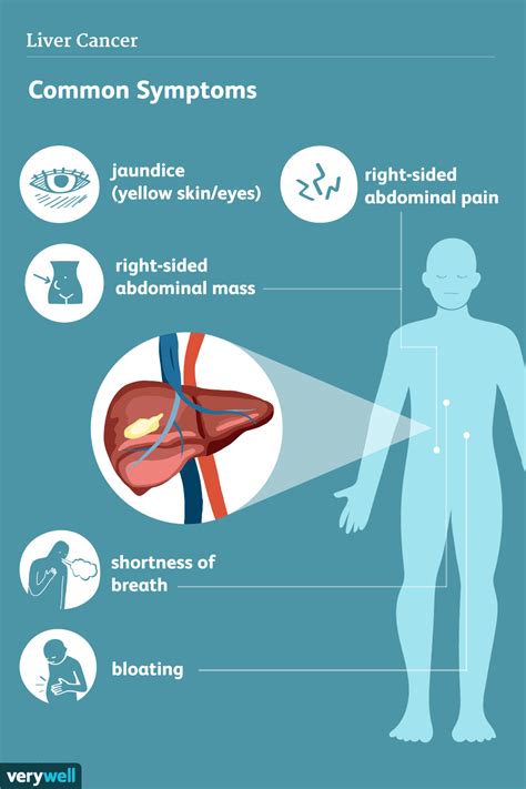 Symptoms of Liver Cancer (2022)