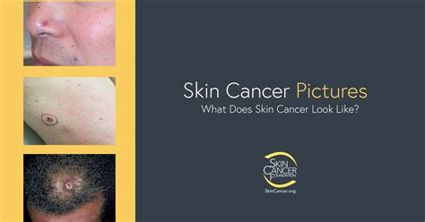 Skin Cancer On Face Early Signs