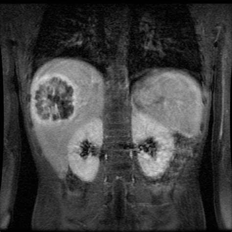 Radiology Cases: Pyogenic Liver Abscess