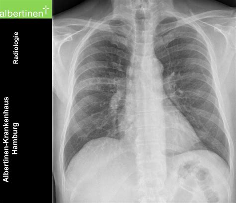 Atypical Pneumonia Chest X Ray