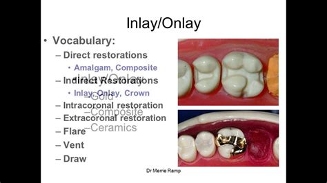 Introduction to inlays/onlays - YouTube