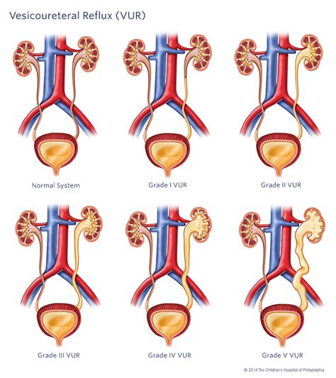 Diverging Lives: Vesicoureteral Reflux (or VUR)