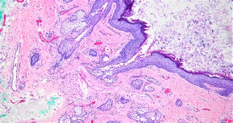 Dermoid Cyst Ovary Eye