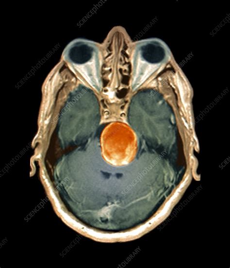 Brain aneurysm, MRI - Stock Image - C023/9781 - Science Photo Library