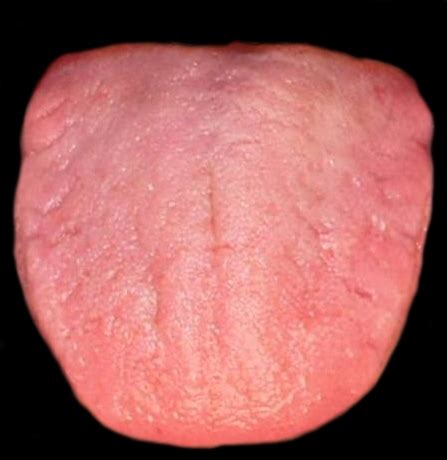 What is Fissured Tongue? - Geographic Tongue | Healthy Tongue Secrets