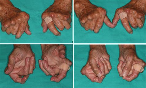 Artritis reumatoide en mano: cirugía e inserción de prótesis