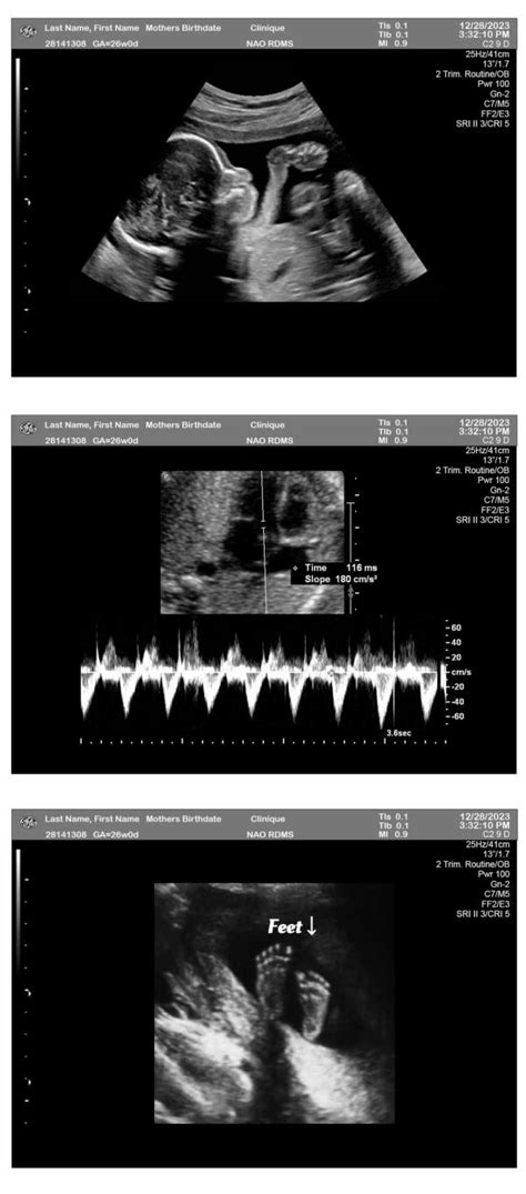 26 Weeks Ultrasound - Ultrasounds