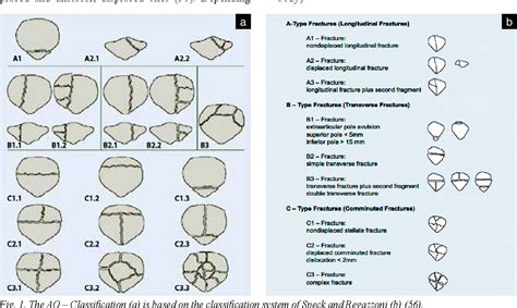 Types Of Patella Fracture