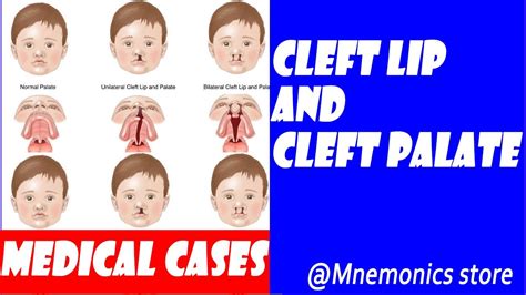 CLEFT LIP AND CLEFT PALATE. TYPES/CAUSES/TREATMENT/PREVENTION. - YouTube