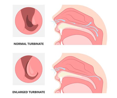 What Causes Swollen Nasal Passages