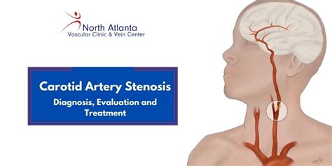 Carotid Artery Stenosis- Diagnosis, Evaluation and Treatment