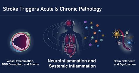 Stroke - NeuroTrauma Sciences