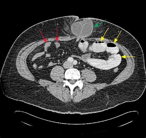 Bowel Obstruction - Small & Large - Causes, Symptoms, Treatment