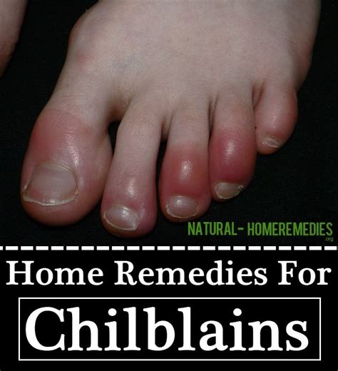 10 Home Remedies For Chilblains | Home remedies, Remedies, Skin care