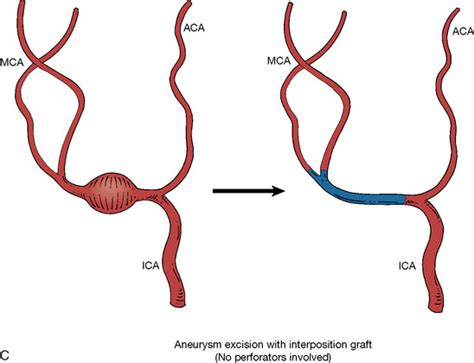 Bypass Surgery for Complex MCA Aneurysms | Neupsy Key