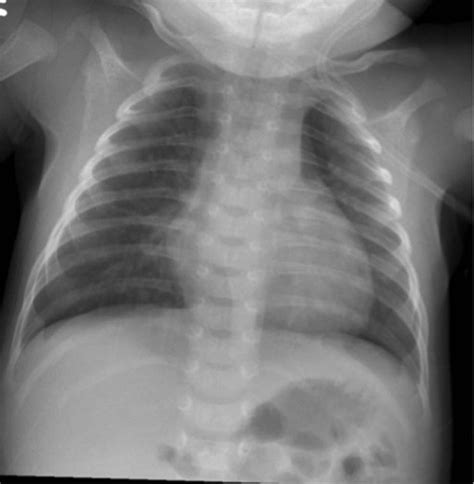 Chest radiograph showed bilateral perihilar hazy infiltrates that were... | Download Scientific ...