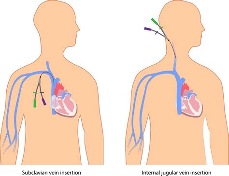 A Nurse Has Just Inserted a Peripheral Iv Catheter for a Continuous Infusion To Secure the ...