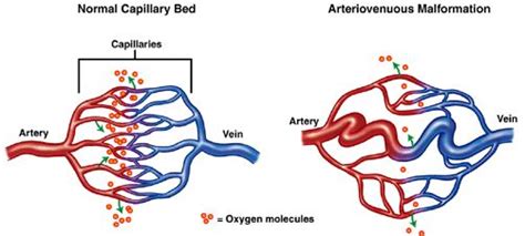 Arteriovenous Malformation - Pictures, What is?, Types, Causes