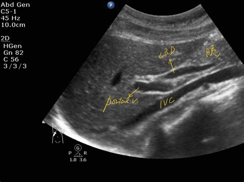 [Sonoanatomy] Pancreas, splenic vein, SMV | Ultrasound sonography ...