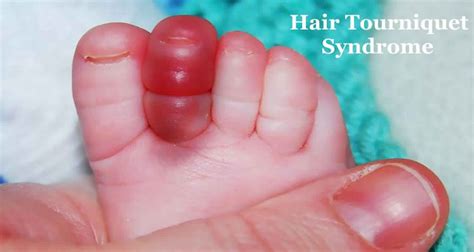 Hair tourniquet syndrome causes, symptoms & treatment