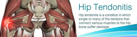 Hip Tendonitis - Cause, Symptoms, Treatment, Exercise