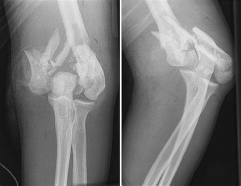 [PDF] Distal humerus fractures. | Semantic Scholar