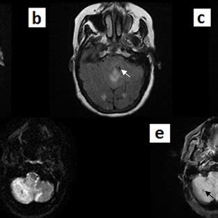 brain MRI revealing a right cerebellar stroke with evidence of... | Download Scientific Diagram