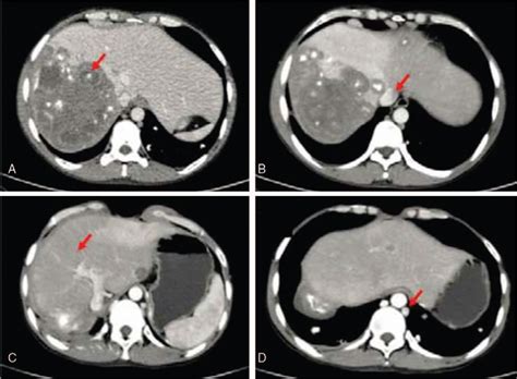 Combined resection of the right liver lobe and retrohepatic... : Medicine