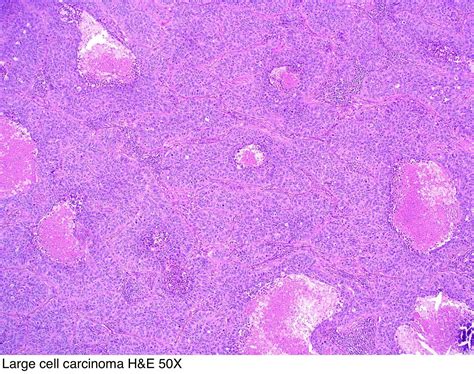 Pathology Outlines - Large cell