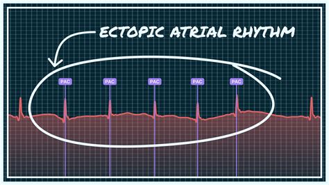 What Ectopic Atrial Rhythm Looks Like on Your Watch ECG | Qaly