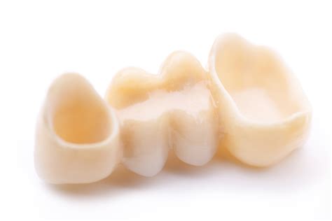 Ventajas y desvantajas del puente dental fijo – Estudi Dental Barcelona