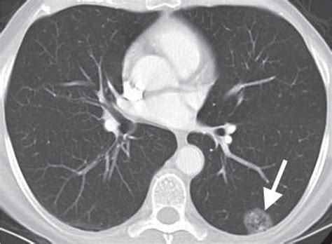 Solitary and Multiple Pulmonary Nodules | Radiology Key