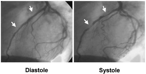 Update on Myocardial Bridging | Circulation