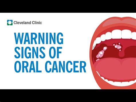 Early Detection and Treatment of White Spots Throat Cancer - CancerWalls