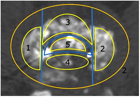 Fusion area in the implanted cage. 1: Decompression zone. 2:... | Download Scientific Diagram