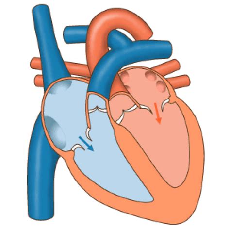 Ventricular Tachycardia - Physiopedia