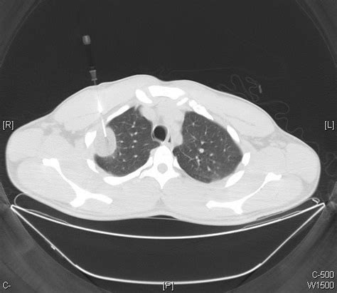 Pleural lipoma - CT scan Case 197 | Flickr - Photo Sharing!