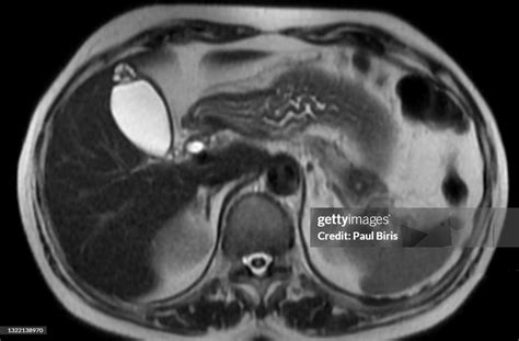 Adenomyomatosis Of The Gallbladder Axial T2 Mri Image High-Res Stock Photo - Getty Images