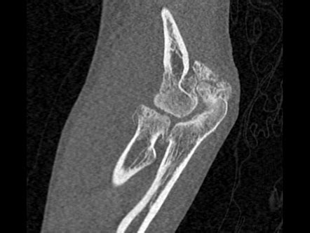 Elbow osteoarthritis with synovial chondromatosis of subtendinous olecranon bursa | Radiology ...