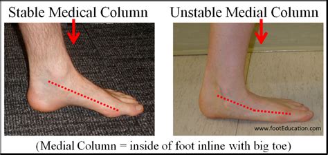 Characteristics of a Flat Foot - FootEducation