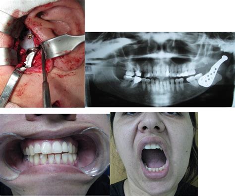 Reconstruction of TMJ with Prosthesis Joint | IntechOpen