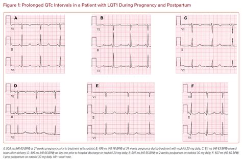 Prolonged QTc Intervals in a Patient with LQT1 During Pregnancy and Postpartum | Radcliffe ...