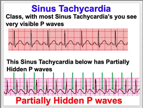 EKG Sept 28 - Oct 2